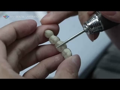 धातु सिरेमिक पुल